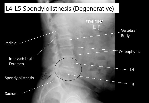 X-ray showing degenerative spondylolisthesis of the L4-L5 vertebrae.