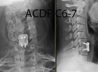 Post-op X-ray of Anterior Cervical Discectomy and Fusion C6-7