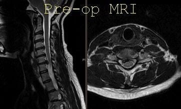 Pre-op MRI of right-sided C6-7 Disc herniation
