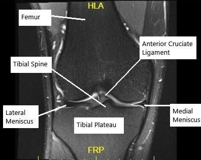 Resonancia magnética de la rodilla en la sección coronal que muestra un LCA intacto.