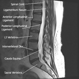 MRI of the lumbar spine in sagittal section showing cauda equina (horse’s tail)