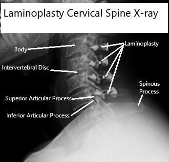 AP and Lateral view X rays of Laminoplasty C3-6