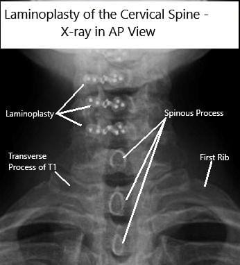AP and Lateral view X rays of Laminoplasty C3-6