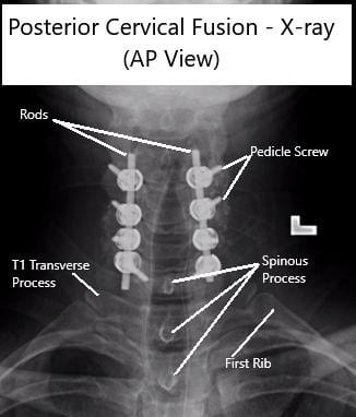 AP and Lateral View X-rays of Posterior Cervical Laminectomy and Fusion