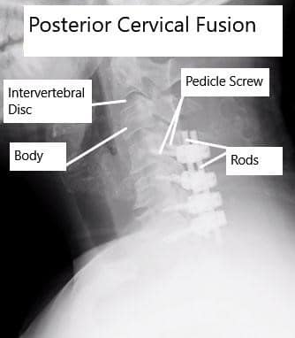 AP and Lateral View X-rays of Posterior Cervical Laminectomy and Fusion