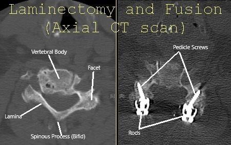 Cervical Spine Axial CT scan showing Laminectomy and fusion.