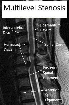 MRI (Sagittal) Cervical spine with multilevel stenosis