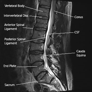 Sagittal section of the lumbar spine on an MRI.