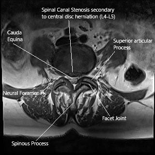 MRI of the Lumbar spine in axial section central disc herniation.