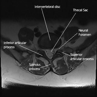 Axial section of the lumbar spine at L5 level.