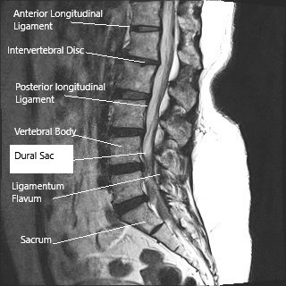 Sagittal section (MRI) of the lumbar spine showing dural sac.