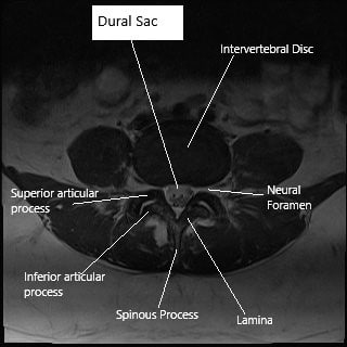 Axial section (MRI) of lumbar spine showing dural sac.