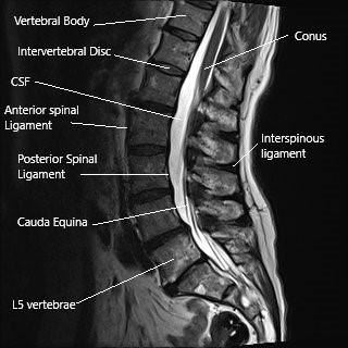 MRI of the lumbar spine showing the interspinous ligament and the spinous process.