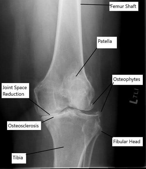 X-ray showing osteoarthritis of the knee.