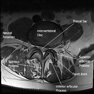 Laser spine surgery may be used to treat herniated intervertebral disc as seen on this axial MRI section of the lumbar spine.