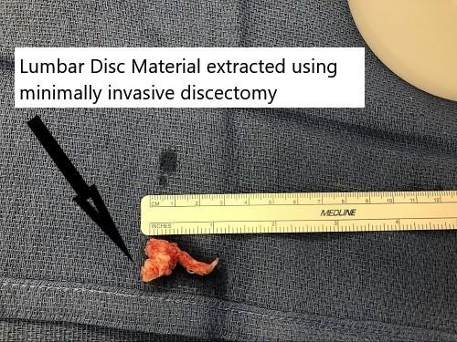 Intraoperative image showing the extracted disc material.
