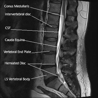 MRI showing sagittal section of the lumbar spine.