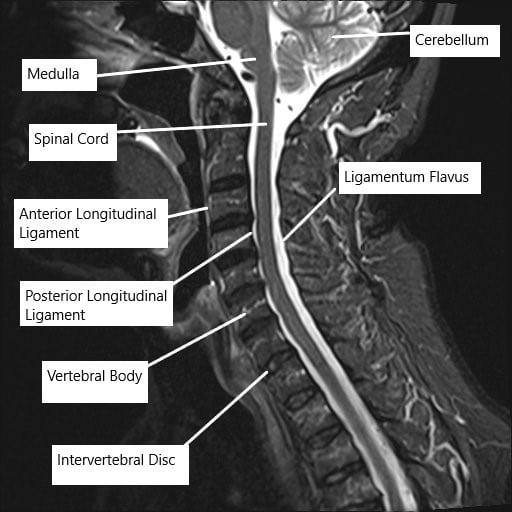 MRI of the cervical spine showing the various ligaments surrounding the spinal cord.