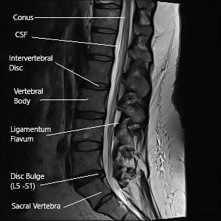 Piriformis Syndrome - Plainsboro Township, NJ: Regenerative Spine