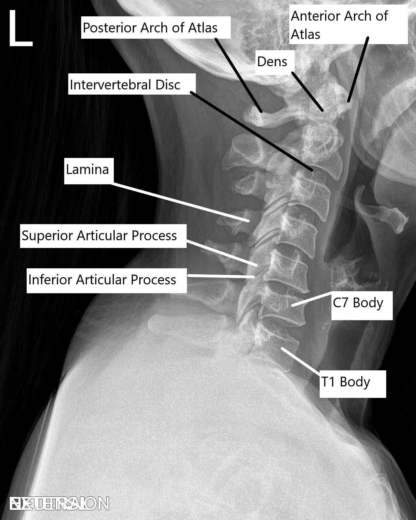 Cervical Spine X-ray in Lateral view.