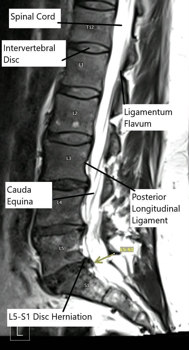 Sagittal section of the lumbar MRI showing L5-S1 disc herniation.