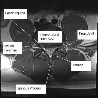 MRI image in axial section showing lumbar spine at the level of L5-S1.