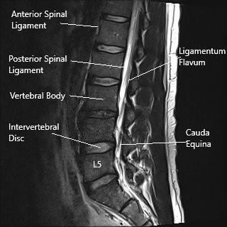 MRI image in sagittal section showing lumbar spine.