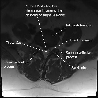 Sección axial de la columna vertebral en la resonancia magnética que muestra hernia de disco intervertebral.