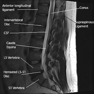 MRI of the lumbar spine in sagittal section showing herniated L5-S1 intervertebral disc.