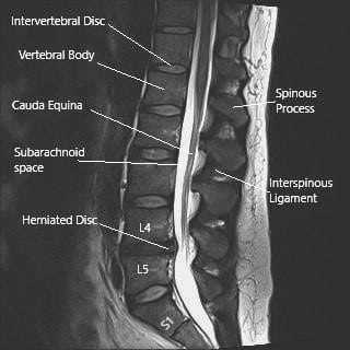 MRI image of the lumbosacral spine in sagittal section showing herniated intervertebral disc at L4-L5 level.