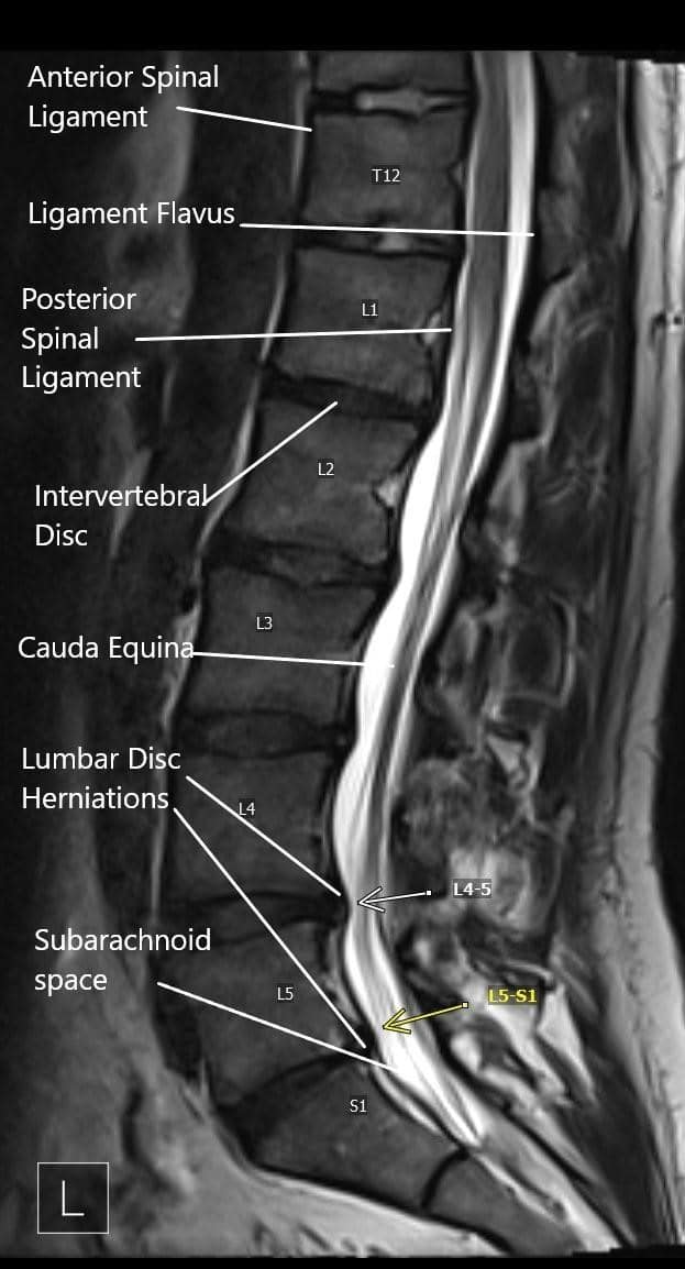 Sagittal section of the lumbosacral on MRI.