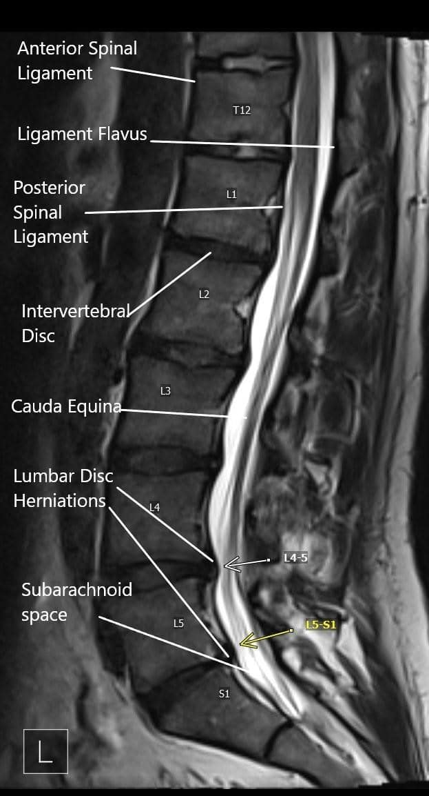Sciatica Nerve Lumbar Radiculopathy Complete Orthopedics