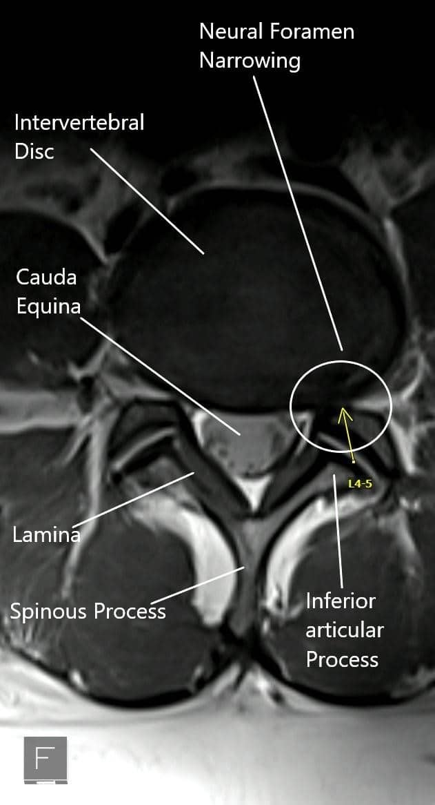 MRI showing the axial section of the lumbar spine with neural foramen narrowing.