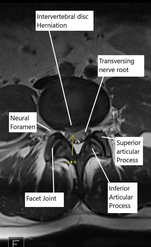 Axial section of the Lumbosacral MRI at L4-L5 level.