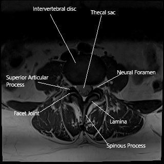 MRI axial section showing the facet joint.