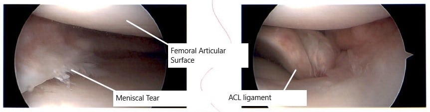 Intraoperative arthroscopic image of the left knee.