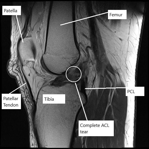 MRI of the left knee showing complete tear of the ACL.
