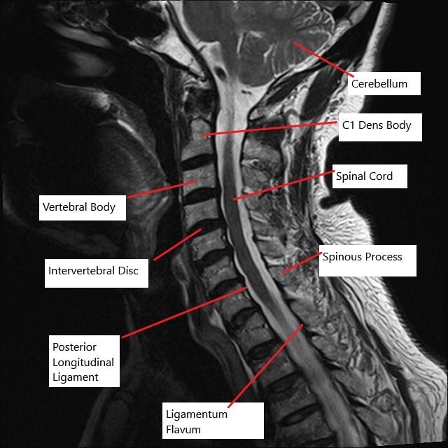 MRI of the cervical spine in the sagittal section showing multiple bulging intervertebral discs.