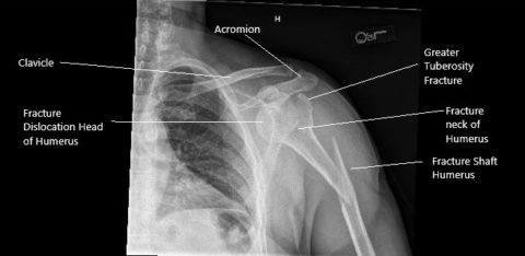 Case Study: Management of Fracture Dislocation of the Glenohumeral ...