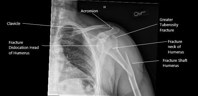 Pre-operative x-ray of the left shoulder in AP view.
