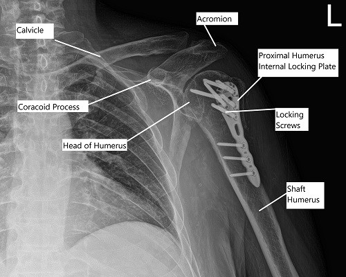 Post-operative x-ray of the left shoulder in AP view.