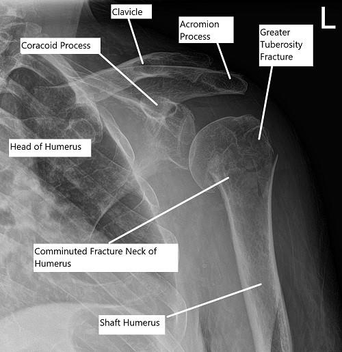 Pre-operative x-ray of the shoulder showing a three-part fracture of the proximal humerus.