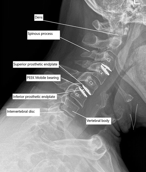 Post-op x-ray of the cervical spine showing total cervical disc replacement at C3-C4 and C5-C6 level.