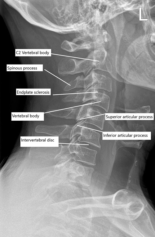 Pre-operative x-ray of the cervical spine in lateral view.