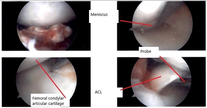 Intraoperative arthroscope image of the right knee.