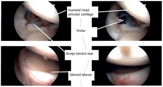 Intraoperative arthroscopic images of the shoulder joint.