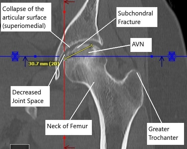 Non-contrast CT image showing AVN changes in the left head of the femur.