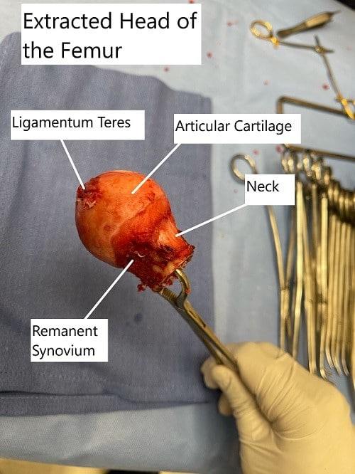 Intraoperative extracted head of the femur with a coronal cut section showing the avascular necrotic area in the superior medial head.