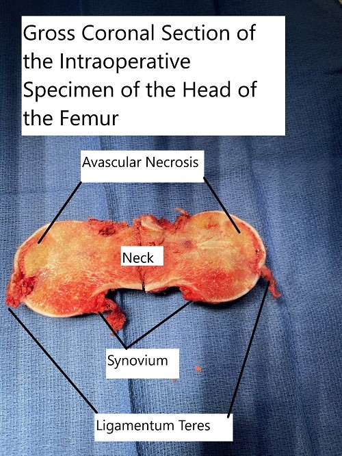Intraoperative extracted head of the femur with a coronal cut section showing the avascular necrotic area in the superior medial head.