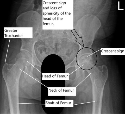 Total Hip Replacement Management of Necrosis | Complete Orthopedics